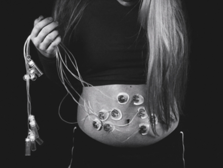 photo of woman in black and white with medical wires on her stomach - photo by Emily Bentley